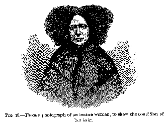 Fig. 19 -- From a photograph of an insane woman, to show the condition of her hair.