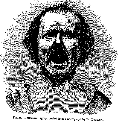 Fig. 21. -- Horror and Agony, copied from a photograph by Dr. Duchenne.