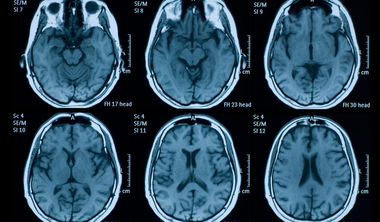 A brain MRI featuring photos of six different views of the brain.