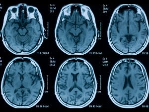 A brain MRI featuring photos of six different views of the brain.