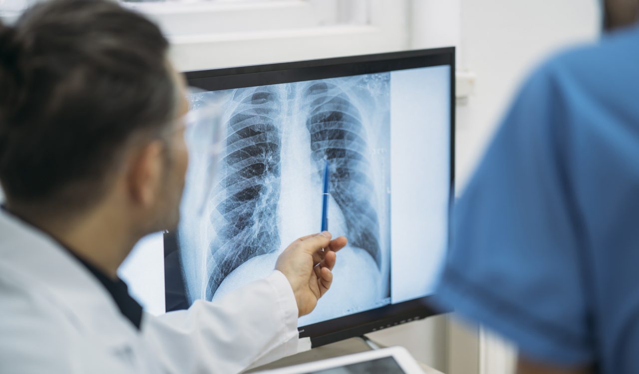 Close-up of two medical professionals looking at an x-ray of a the lungs and ribs.