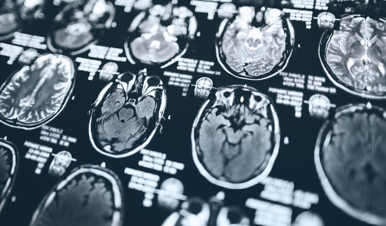 MRI scans of human brains.