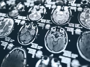 MRI scans of human brains.