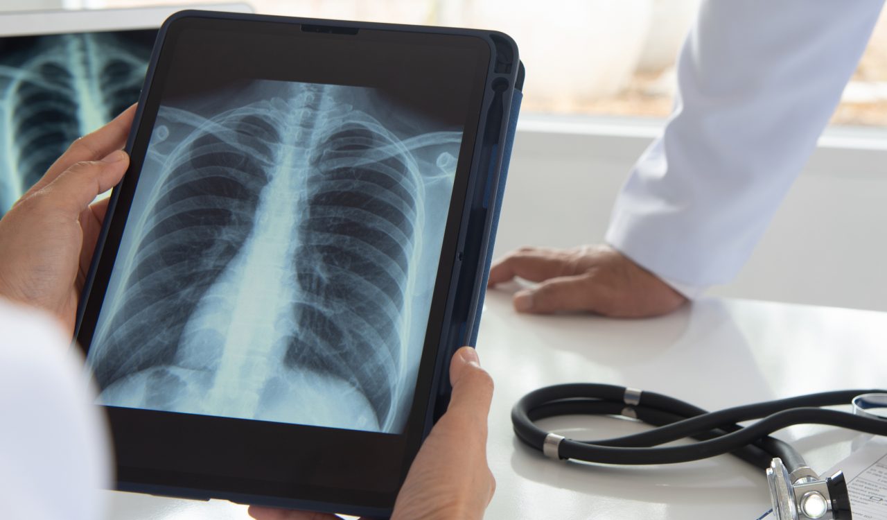 Close-up of a tablet displaying an x-ray of someone's lungs and chest. It is being held by a doctor.
